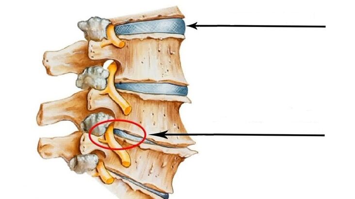 tatu tulang tonggong dina kasus osteochondrosis serviks