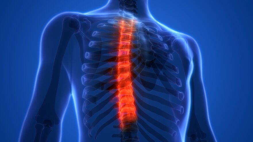 Osteochondrosis tina tulang tonggong thoracic, dicirikeun ku karuksakan cakram intervertebral. 