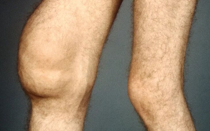 Arthrosis postaiumatik tina gabungan dengkul