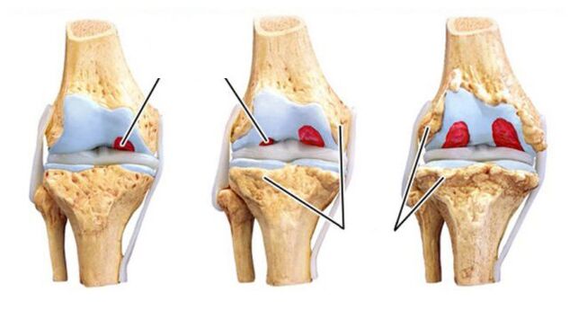 komplikasi tina arthrosis of mendi