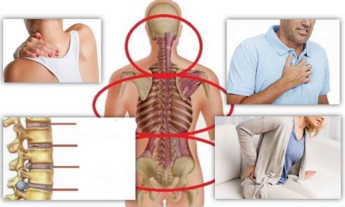 Tempat-tempat panyakit pikeun osteochondrosis