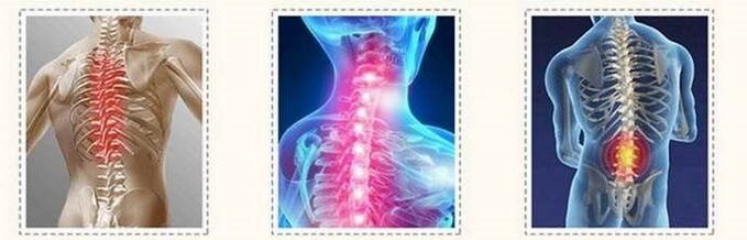 lesi ostheoshristrathosis tulang tonggong