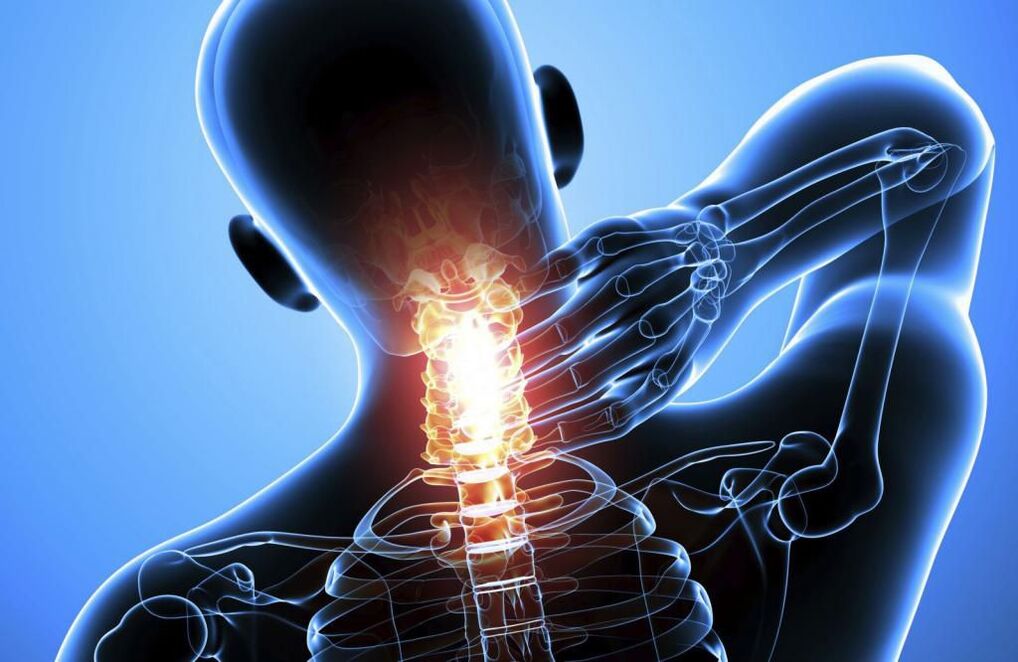 Osteochondricosis tulang tonggong cervical