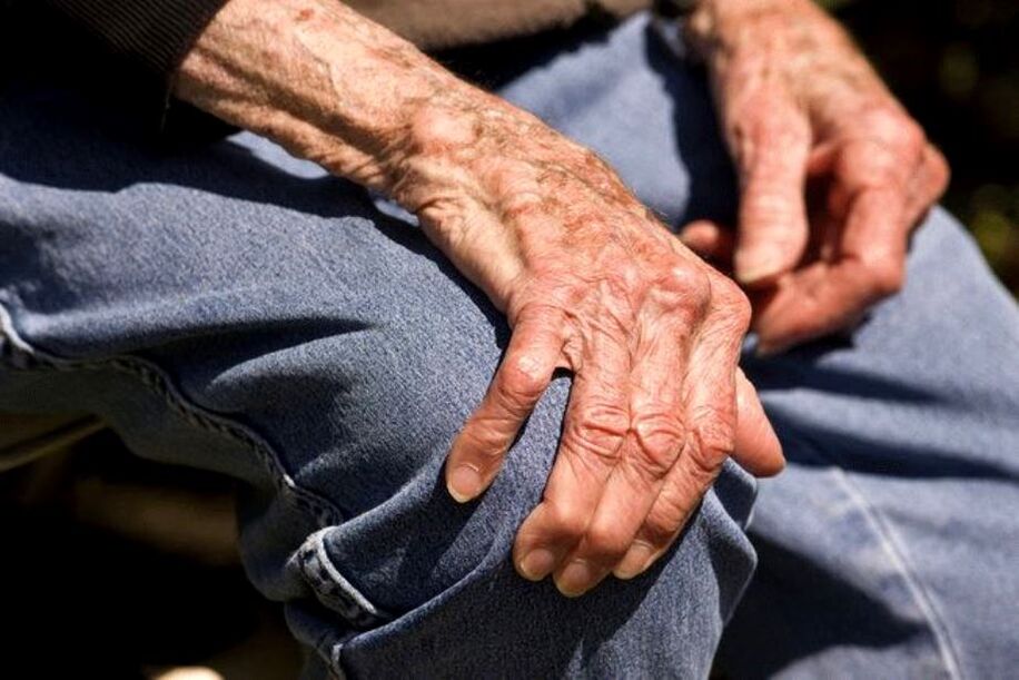 Arthrosis mangrupikeun panyakit anu aya hubunganana sareng umur anu lumangsung dina jalma sepuh