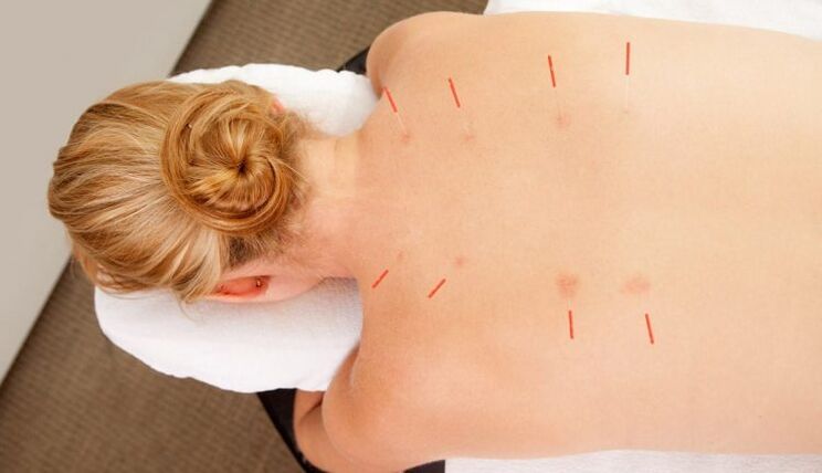 Akupungtur pikeun osteochondrosis thoracic, nu boga loba kaunggulan